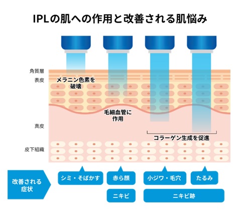 フォトフェイシャルの効果
