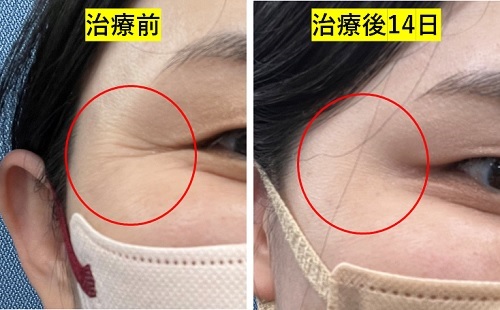 目尻にボトックス注射