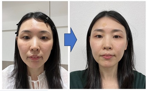 フェイスラインへのヒアルロン酸注入