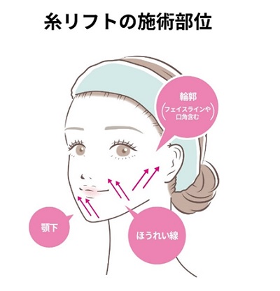 糸リフトの施術部位