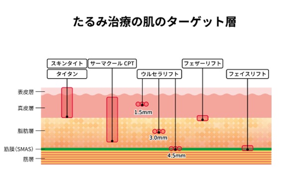 高周波治療のターゲット