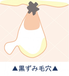 毛穴の黒ずみ