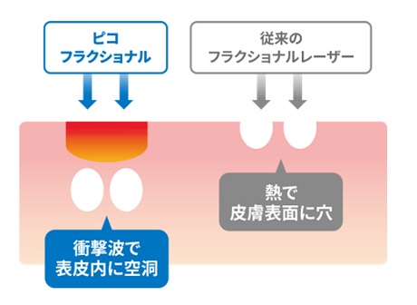 ピコフラクショナルと従来のフラクショナルの違い