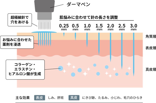 ダーマペンの効果と針の長さ