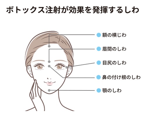 ボトックス注射が効果を発揮するシワのイラスト