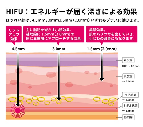 HIFU（ハイフ）の効果
