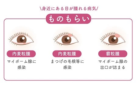 身近な麦粒腫