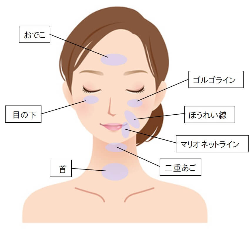 顔のたるみができやすいところ