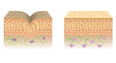 若い健康な肌と老人性乾皮症の比較図