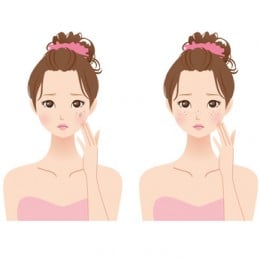 肝斑に悩む女性