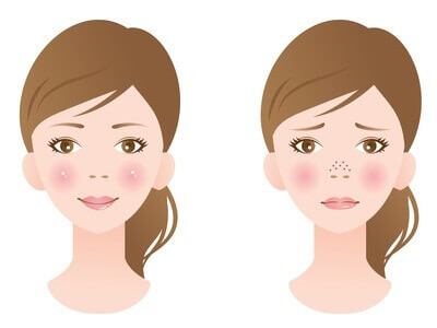 いちご鼻の女性といちご鼻でない女性のイラスト