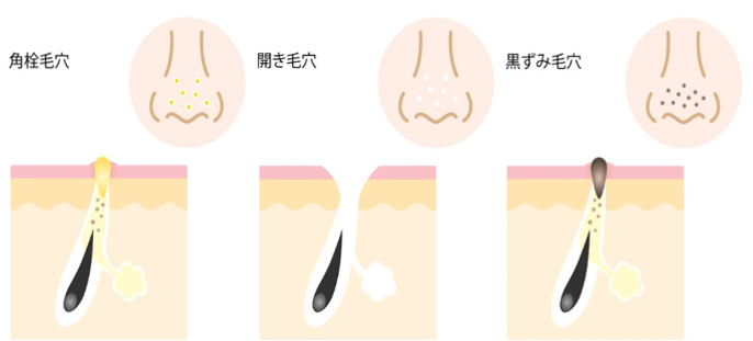 角栓が原因の毛穴の種類のイラスト