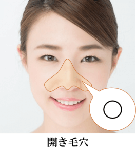 開き毛穴の形と目立ちやすいパーツを示す写真