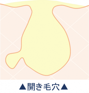 開き毛穴