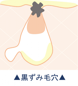 黒ずみ毛穴