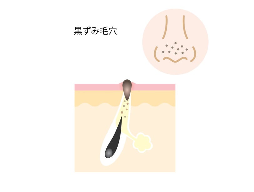 黒ずみ毛穴の図