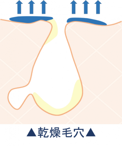 乾燥毛穴
