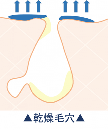 乾燥毛穴のイラスト
