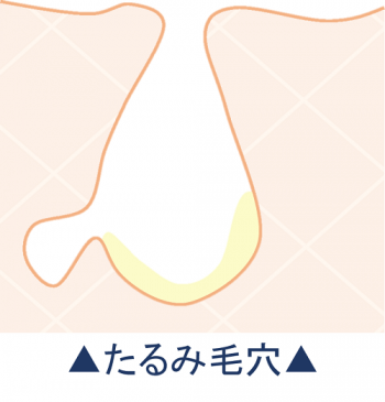 たるみ毛穴の断面図のイラスト