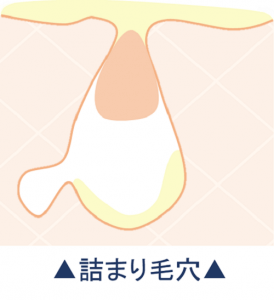 詰まり毛穴