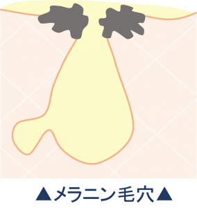 メラニン毛穴を表したイラスト