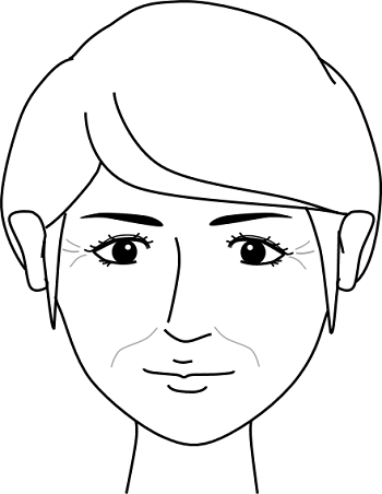 表情が元へ戻っても少ししわが目立つ状態の女性