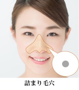 詰まり毛穴が目立ちやすい部位