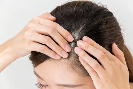 ヘアカラーで化粧品かぶれをおこす女性