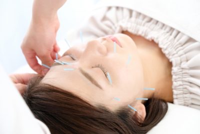 美容鍼を受ける女性