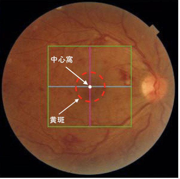 加齢黄斑変性症を発症した目