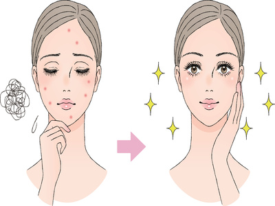 にきびが気になる女性がスキンケアで改善した様子