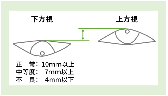 上眼瞼機能検査のイラスト