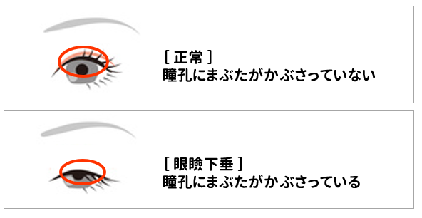 眼瞼下垂セルフチェック