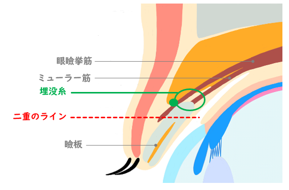 眼瞼下垂の埋没法のイラスト