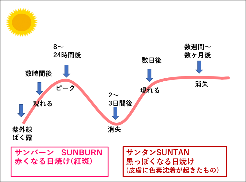 サンバーンとサンタンの違いを表した図