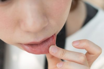 口の傷の粘膜が気になる女性