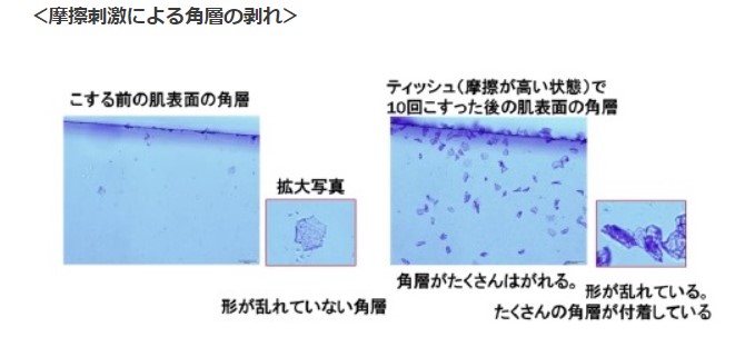 摩擦刺激による角層のはがれの写真