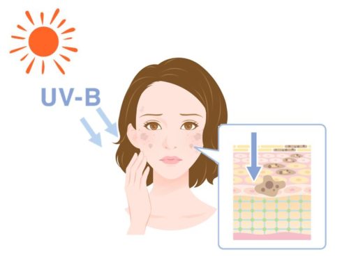 紫外線により表皮がダメージを受ける女性