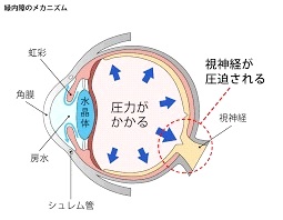 緑内障のメカニズムの図