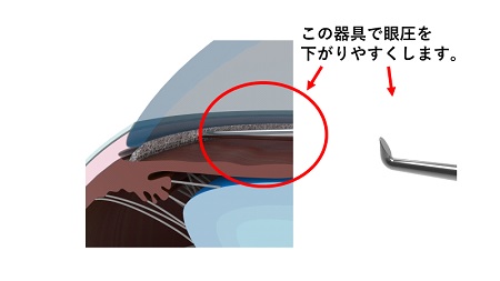 眼圧を下がりやすくする器具