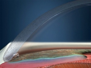 iStent(アイステント)でデバイスを挿入している図