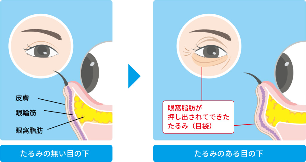 たるみのない目の下とたるみのある目の下を表した図