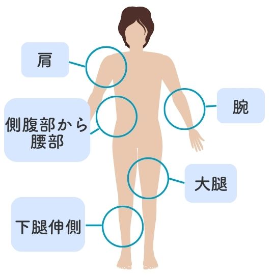 老人性乾皮症の好発部位のイラスト