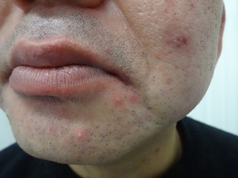 45歳　男性のマスク肌荒れの写真