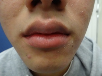 16歳　男性のマスク肌荒れの写真