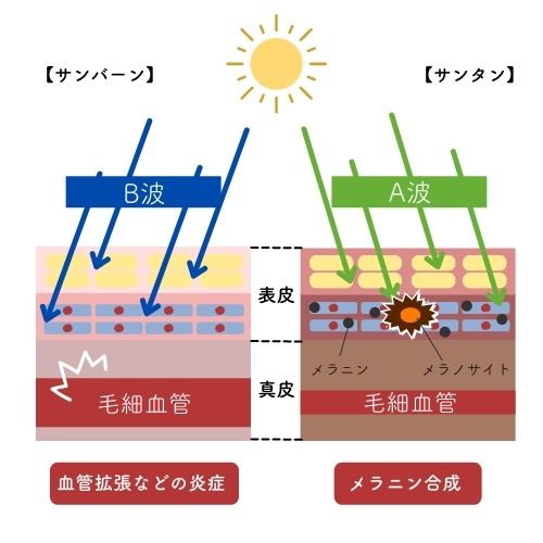 サンバーンとサンタンの皮膚に及ぼすダメージの図