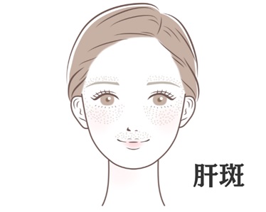肝斑のイラスト