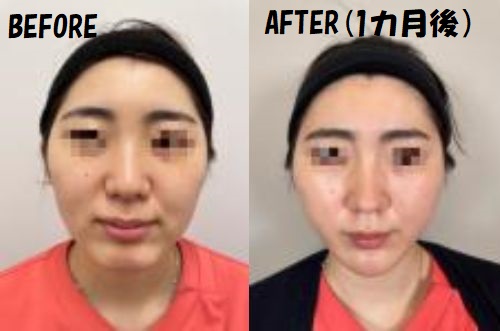 リフトアップ施術を行った女性