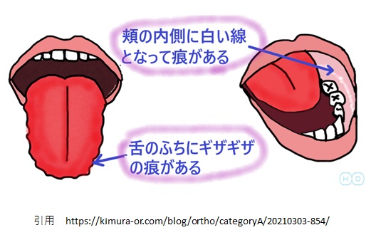 舌の歯型の有無をチェックするイラスト