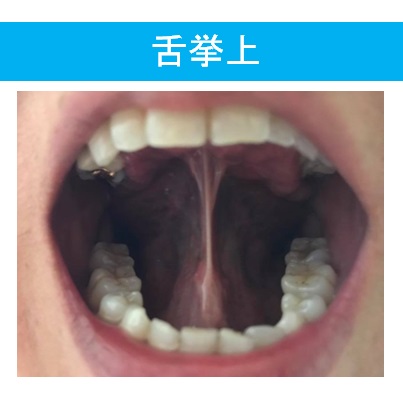 舌を上顎につけた時の良い状態を示す写真